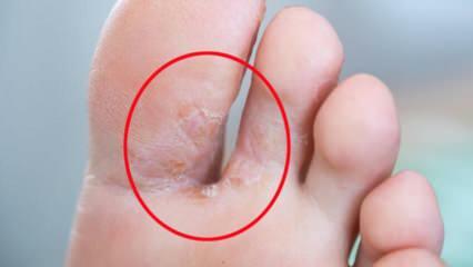 ¿Qué es el hongo del pie? ¿Cuáles son los síntomas del hongo del pie? ¿Existe una cura para el pie de atleta?