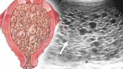 ¿Qué es el embarazo topo (embarazo de uva), cuáles son los síntomas? ¿Cómo entender el embarazo topo?