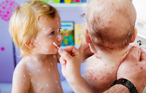 Los síntomas de la varicela en la infancia y la niñez