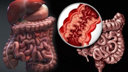 ¿Qué es la enfermedad de Crohn? ¿Cuáles son los síntomas de la enfermedad de Crohn? ¿Existe una cura para Crohn?