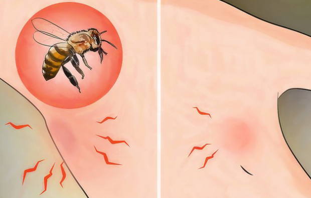 ¿Qué es la alergia a las abejas y cuáles son los síntomas? Métodos naturales que son buenos para las picaduras de abejas.