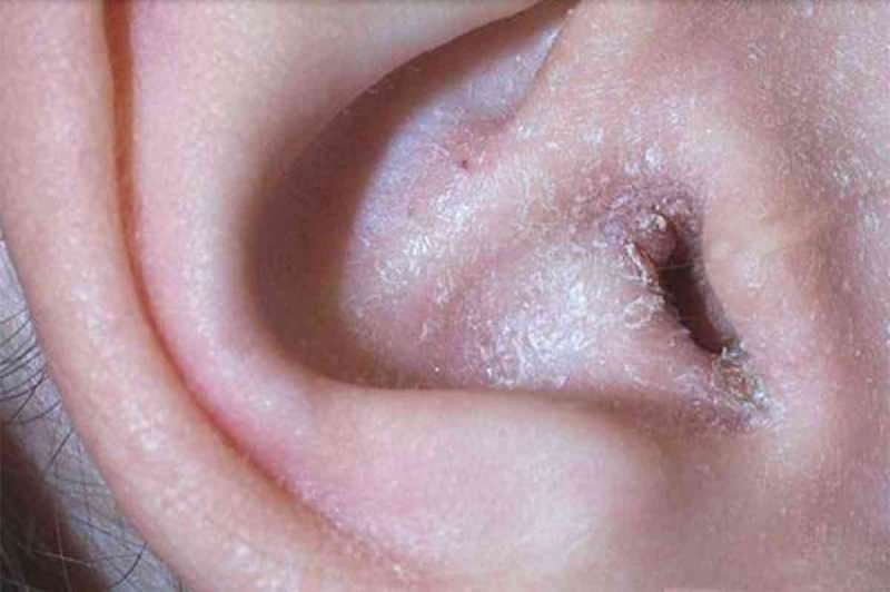 ¿Qué causa la descamación detrás de la oreja y cómo pasa? La solución definitiva para el eccema retroauricular ...