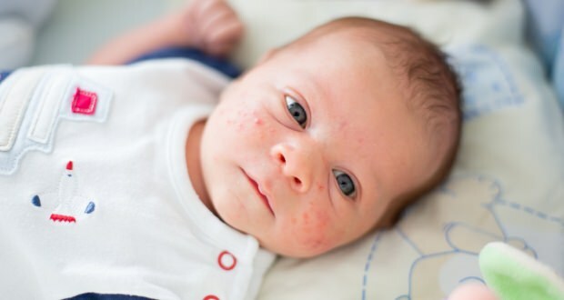 ¿Por qué ocurre el acné en los bebés?