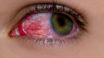 ¿Qué causa la alergia ocular? ¿Cuáles son los síntomas de la alergia ocular? ¿Qué es bueno para las alergias oculares? 