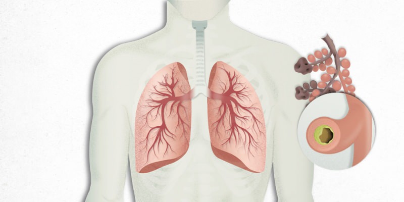 el virus que se instala en los pulmones se mezcla con neumonía