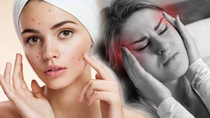 ¿El acné causa dolores de cabeza? ¿Qué hacer contra el acné doloroso? Dolor por acné ...