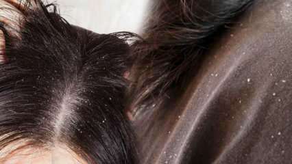 ¿Cómo pasa la caspa y qué es bueno para el cabello con caspa? 5 métodos más rápidos y efectivos para eliminar la caspa