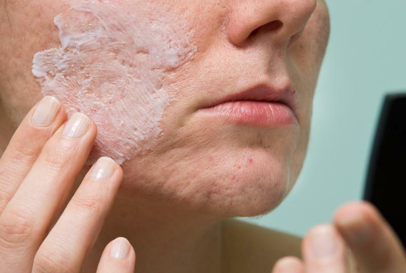 ¿Qué causa el acné inflamado y cómo desaparece? Mascarilla que seca el acné inflamado.