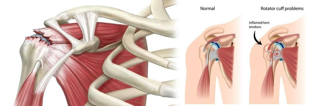 ¿Por qué ocurre un desgarro en el hombro? ¿Cómo se trata un desgarro del hombro?