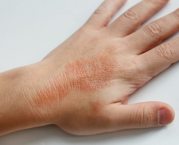eczema en mano