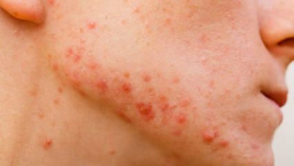 ¿Cómo pasan el acné quístico? ¿Qué es bueno para el acné quístico?