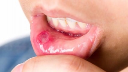 Úlcera en la boca!