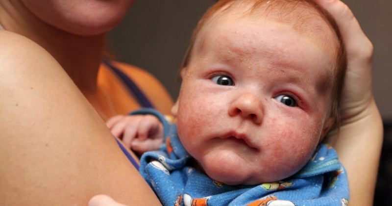 Causas del enrojecimiento de los ojos en los bebés