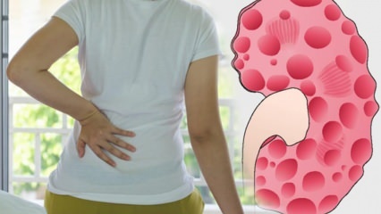 ¿Qué es el agrandamiento del riñón (hidronefrosis)? ¿Causa agrandamiento del riñón? Síntomas de agrandamiento del riñón