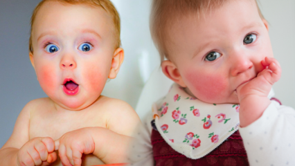 ¡Atención en bebés con mejillas rojas! Síndrome de la mejilla abofeteada y sus síntomas.