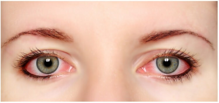 ¿Tiene alergia al rimel y delineador de ojos?
