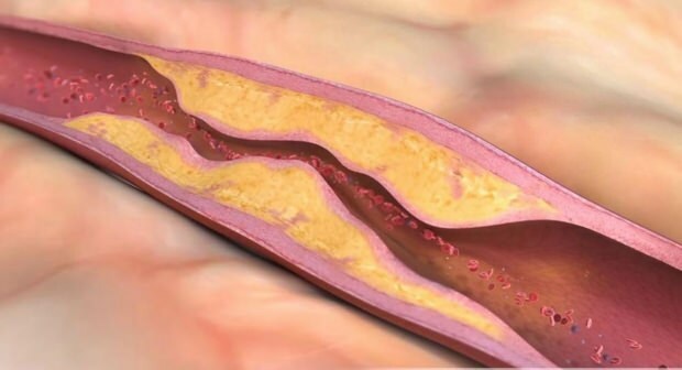 ¿Qué causa la aterosclerosis? ¿Cuántos tipos de oclusión vascular existen?
