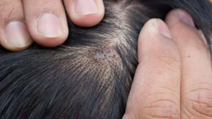 ¿Por qué aparece el acné en el cuero cabelludo? ¿Cómo pasan los granos en el cuero cabelludo?
