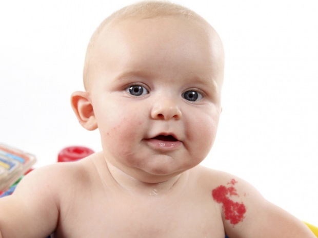 causas de la marca de nacimiento en infantes