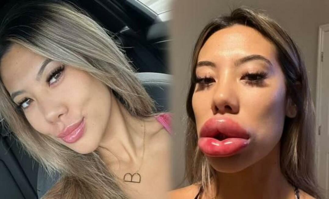 ¡Los labios de la mujer que se hizo rellenos en USA quedaron atónitos!