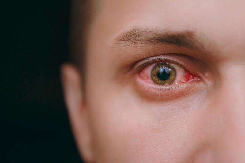 síntomas de coronavirus de lagrimeo, sangrado y picazón en los ojos