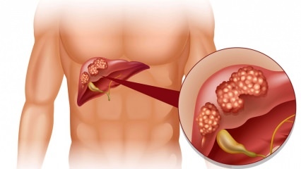 ¿Cuáles son los síntomas del cáncer de hígado? ¿Existe tratamiento para el cáncer de hígado?