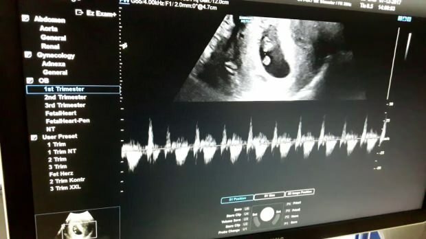 ¿Cuándo se escuchan los latidos del corazón del bebé en el útero de la madre? Si no se escuchan los latidos del corazón del bebé ...