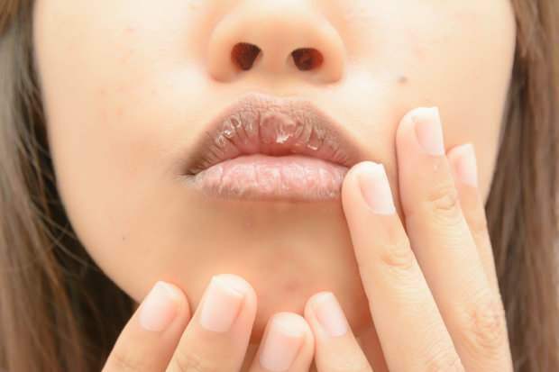 la anemia causa labios secos