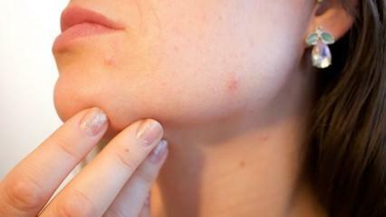 ¿Qué es el cáncer de piel (Melanoma)? ¿Cuáles son los síntomas del melanoma y existe una cura?