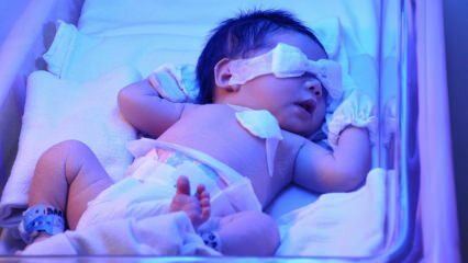 ¿Qué es la ictericia del recién nacido? ¿Cómo pasa la ictericia en los bebés en casa? Grado de ictericia en infantes