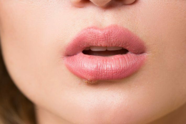 ¿Qué es el cáncer de lengua? ¿Cuales son los sintomas?