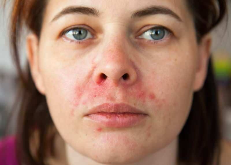 ¿Por qué aparece el acné alrededor del labio? ¿Cómo se trata la dermatitis periódica?