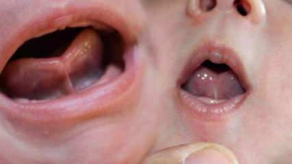 ¿Qué es el enlace de la lengua (Ankyloglossi) en los bebés? Síntomas y tratamiento de la unión de la lengua ...