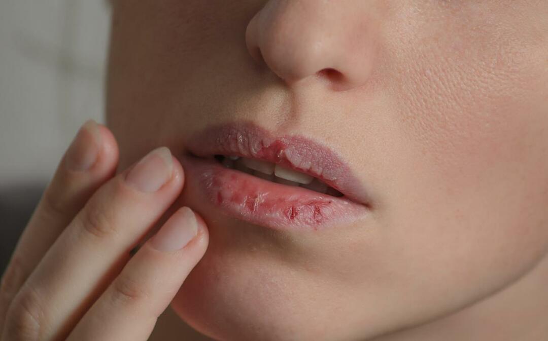 ¿Qué causa los labios oscuros? ¿Cómo se trata el oscurecimiento de los labios o los moretones?