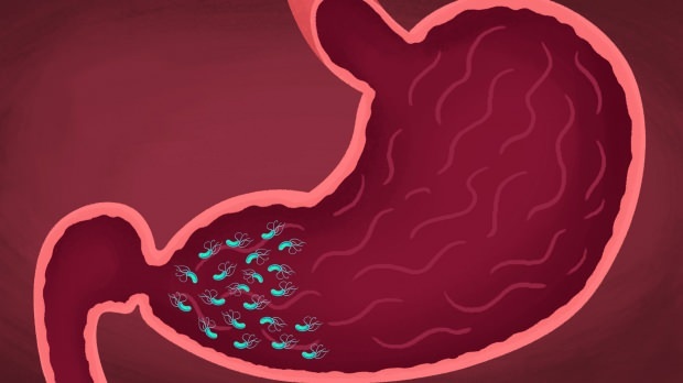 algunos virus y bacterias pueden causar gastritis