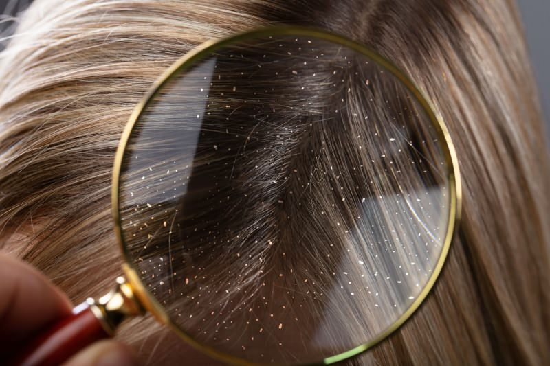 ¿Cómo pasa la caspa y qué es bueno para el cabello? Los 5 remedios para la caspa más rápidos y efectivos