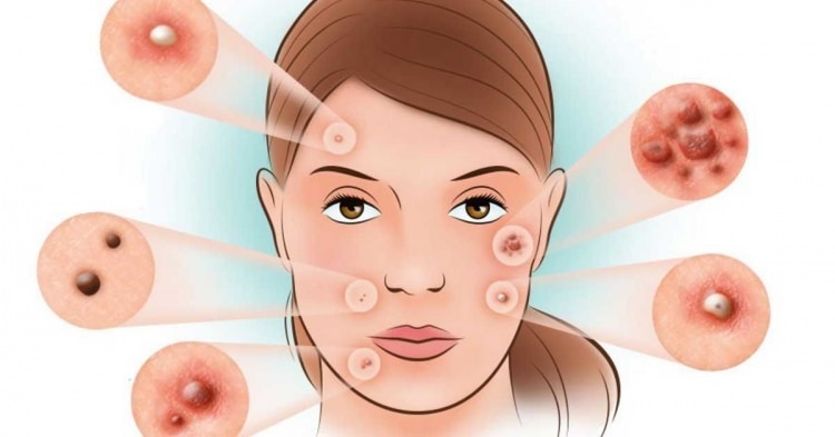 ¿Cómo se trata el acné?