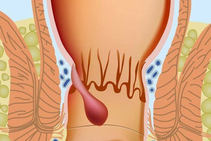 Cómo ocurren las hemorroides en la parte anal 
