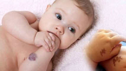 Causa marca de nacimiento en los bebés, ¿es permanente? ¿Cuáles son los tipos de marcas de nacimiento? Cura de Saracoglu