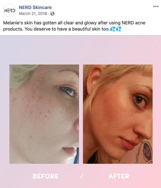 Ejemplo de cómo Nerd Skincare usó una imagen de antes y después para crear una publicación de imagen para las redes sociales que impulsa las compras de sus productos.