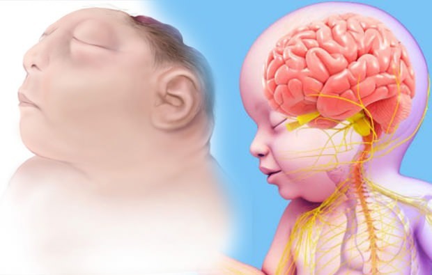 ¿Vive la anencefalia bebé? Diagnóstico de anencefalia