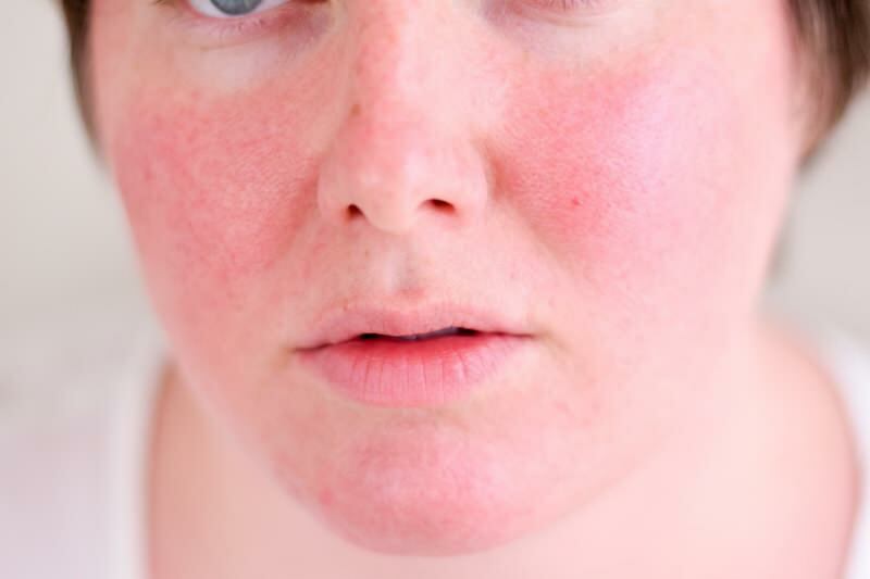 ¿Cómo pasa la cara enrojecida? Los mejores productos para el cuidado contra el enrojecimiento facial