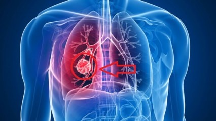 Síntomas del cáncer de pulmón: etapas del cáncer de pulmón!