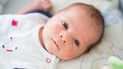 ¿Cómo pasan los granos en la cara del bebé? Métodos de secado del acné (Milia)