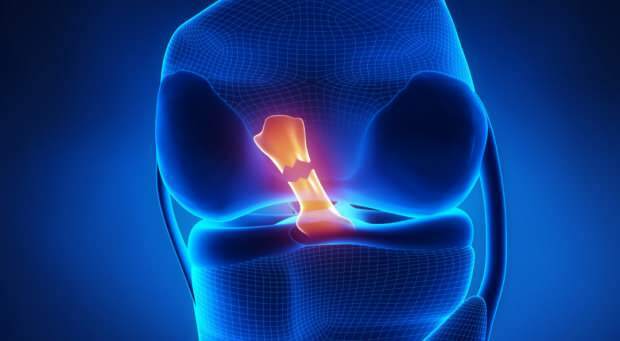 ¿Qué causa la ruptura del ligamento cruzado y cuáles son los síntomas? ¿Existe un tratamiento de ligamento cruzado?