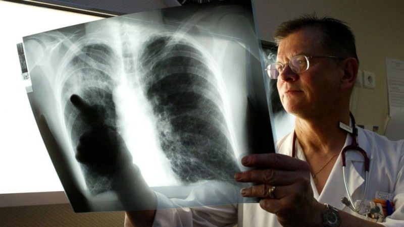 virus legionario se instala en los pulmones 