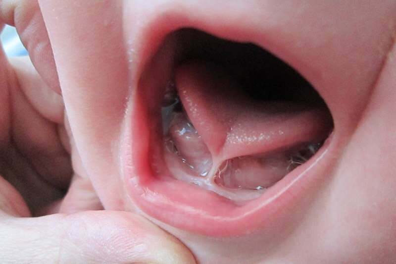 Síntomas y tratamiento de la unión de la lengua en bebés.