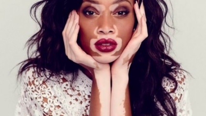 ¿Qué es el vitiligo (enfermedad de blanqueamiento)?