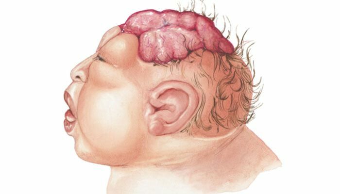 ¿Qué es la anencefalia? ¿Cuáles son los síntomas de la anencefalia en bebés y niños? La anencefalia causa ...