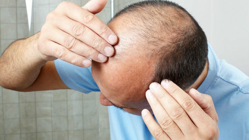 ¿El trasplante de cabello previene el ghusl?